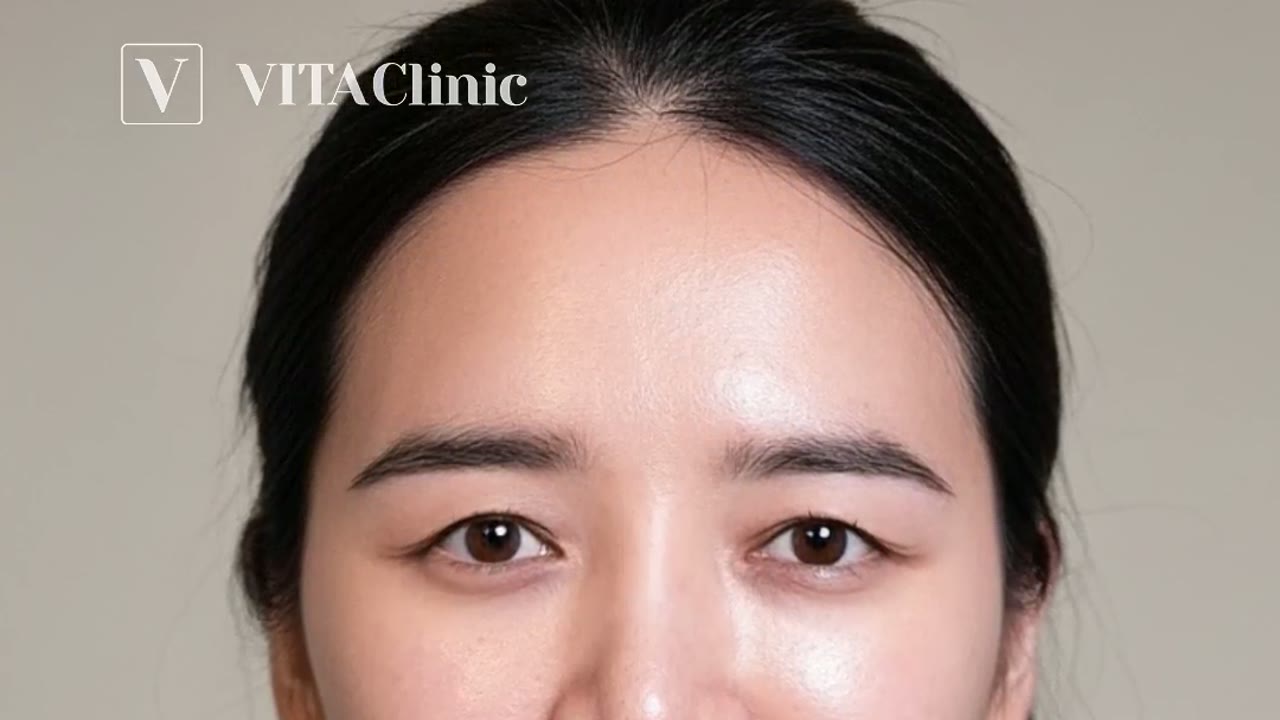 Thermage eye treatment at Vita Clinic